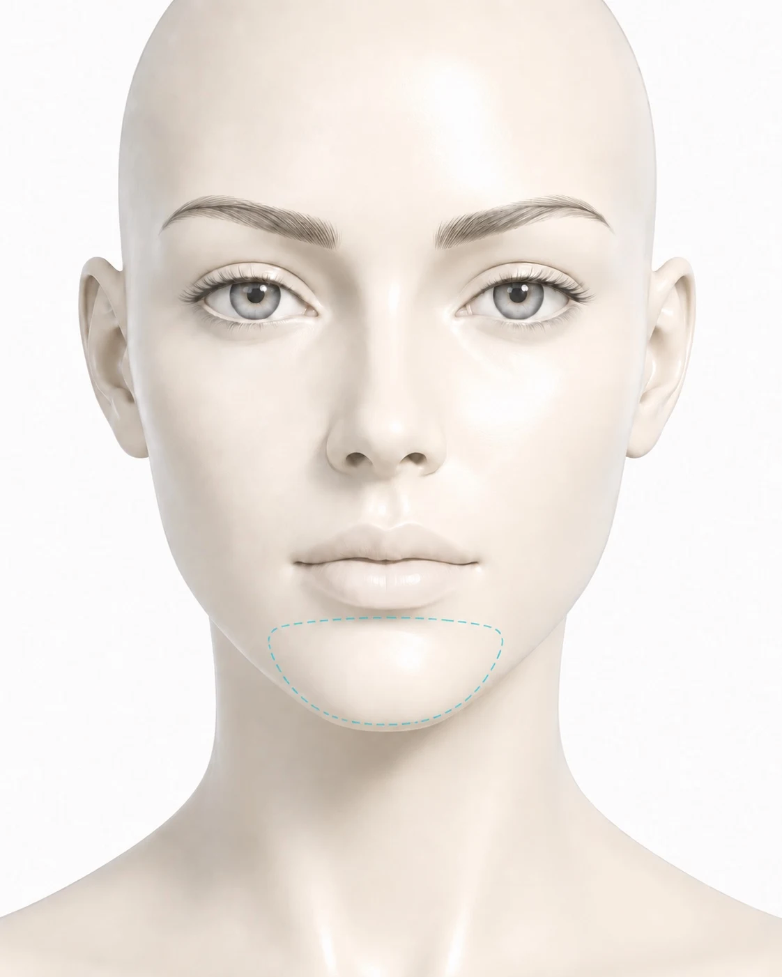 Diagram showing the chin treatment zone marked on the face: a rounded area covering the chin from just below the lower lip down to the jawline.
