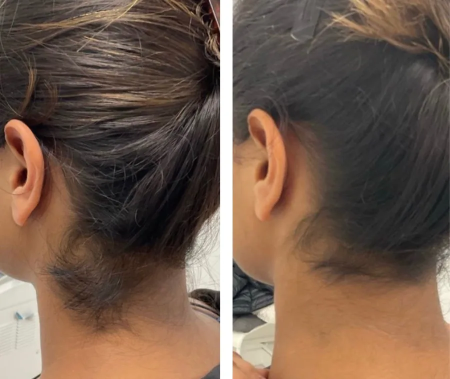 Before and after laser hair removal – Back of neck, treated at Feonix Aesthetics Coventry