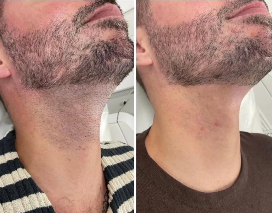 Before and after laser hair removal – Men’s beard & neck, treated at Feonix Aesthetics Coventry