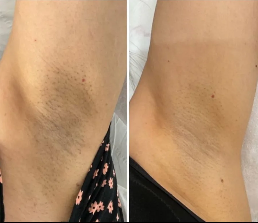 Before and after laser hair removal – Underarms, treated at Feonix Aesthetics Coventry