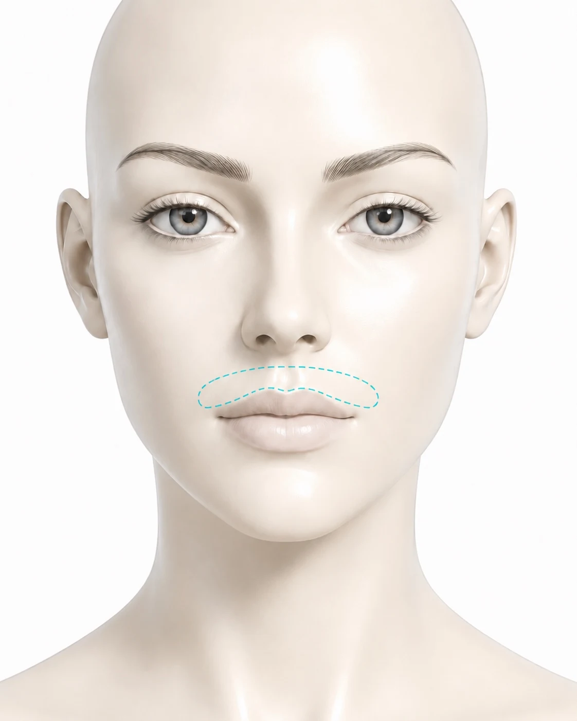 Diagram showing the lip treatment zone marked on the face: the area above the upper lip, between the base of the nose and the lip line, extending to the corners of the mouth.