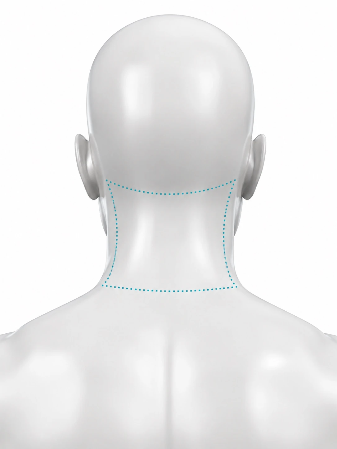 Rear-view diagram with the treatment zone marked on the back of the neck: from the hairline down to the top of the shoulders, and out to behind each ear.