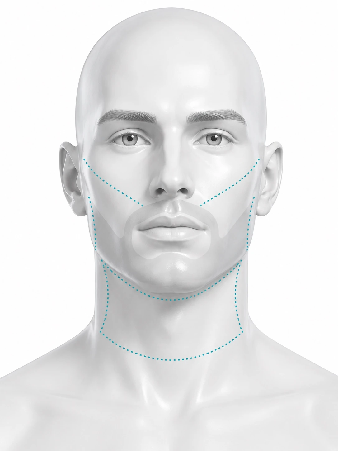 Front-view diagram of a man's face. The beard, moustache and goatee area is shaded to show the hair that is kept. Dashed outlines mark the areas that are treated: the cheeks above the beard line on both sides, and the neck below the jaw down to the collarbone.