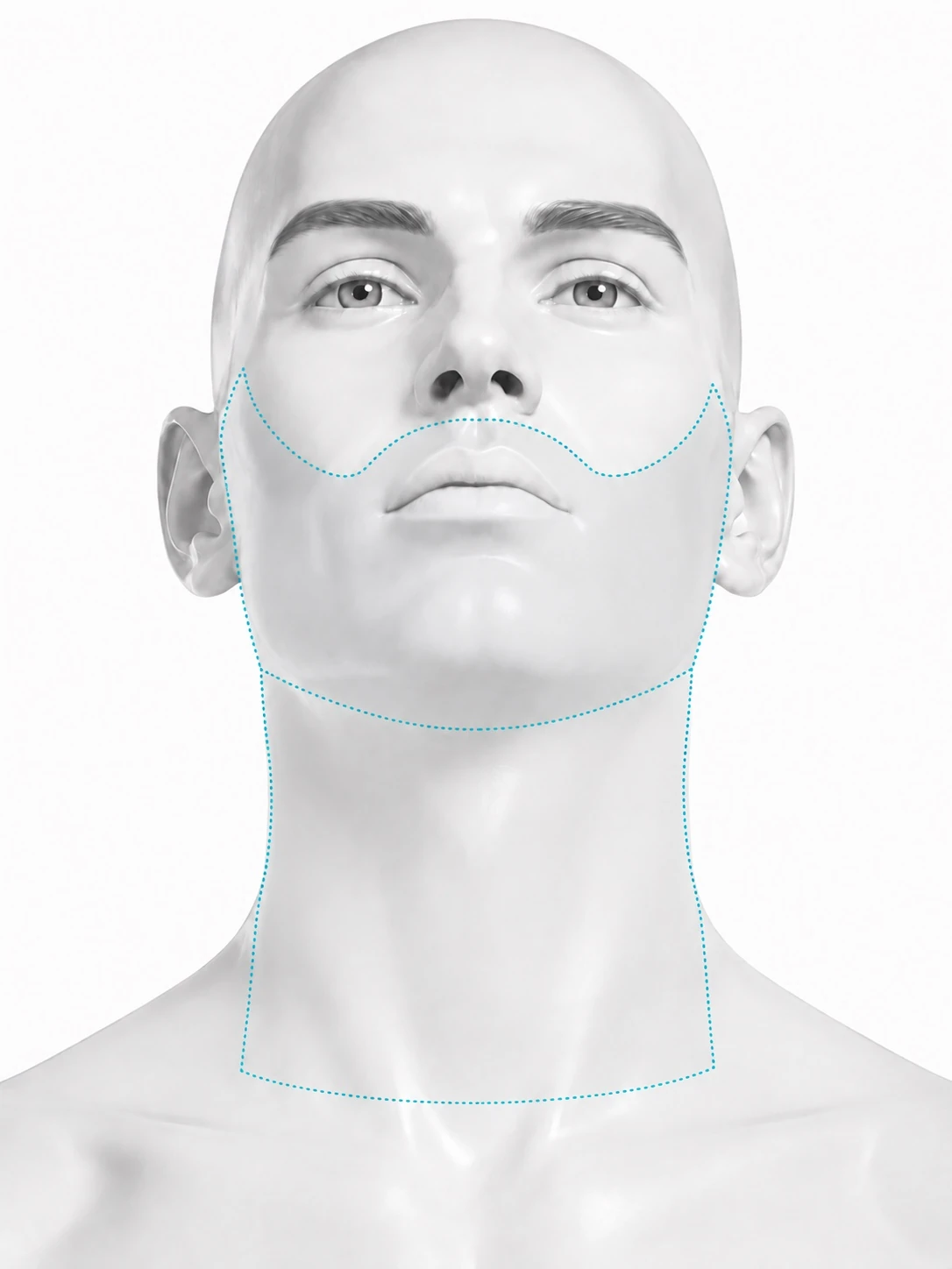 Front-view diagram of a man with the head tilted back and one continuous treatment zone marked: the whole beard area across both cheeks, the moustache area, the chin and jaw, running down over the full front of the neck to the collarbone. The lips are not marked.