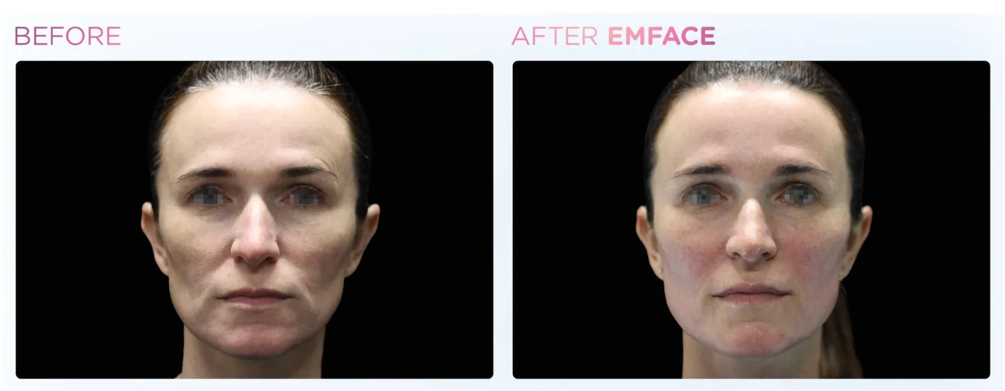 EMFACE manufacturer clinical before-and-after, front view of a woman's face