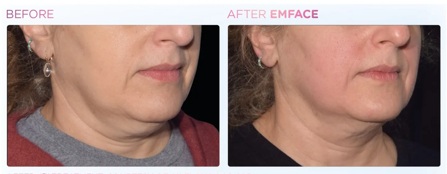 EMFACE manufacturer clinical before-and-after, jawline and under-chin, three-quarter view