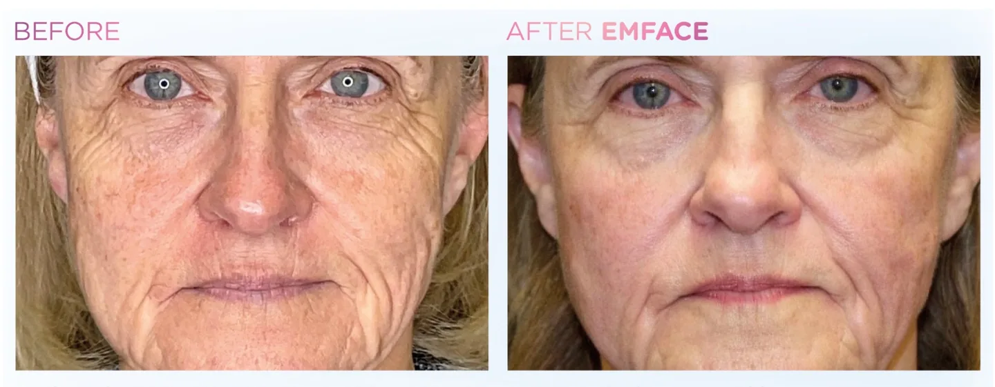EMFACE manufacturer clinical before-and-after, eye area and cheeks