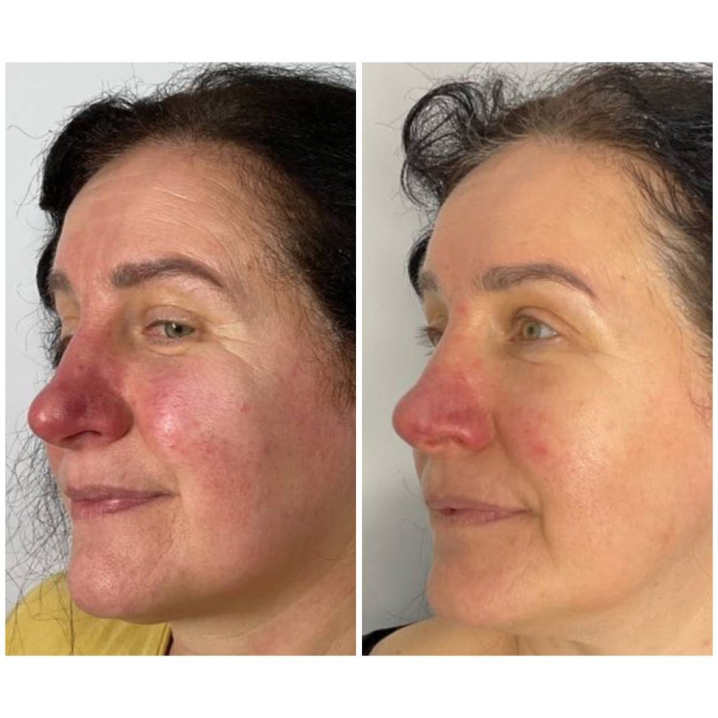Before and after of treating Rosacea with Laser Genesis