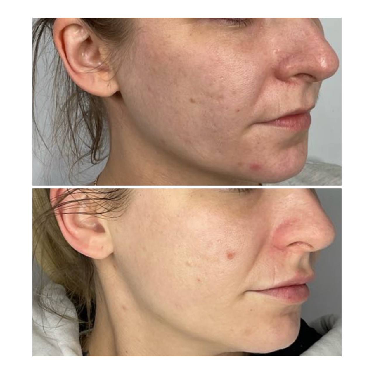 LASER GENESIS FeonixAesthetics