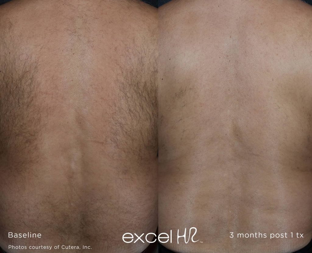 Before & After Laser Hair Removal Back Excel HR