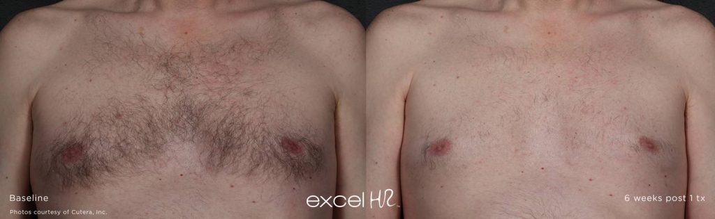 Before & After Laser Hair Removal Chest Excel HR