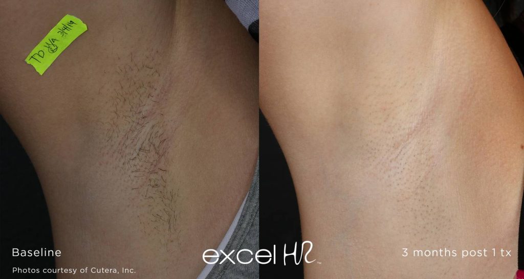 Before & After Laser Hair Removal Underarms Excel HR