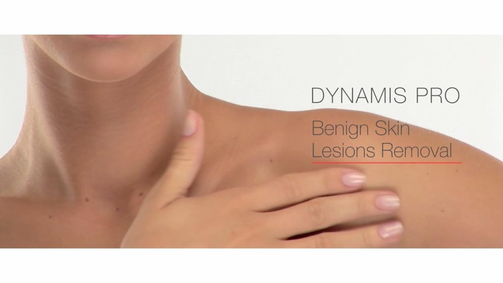 BENIGN SKIN LESION TREATMENT​ Feonix Aesthetics Coventry